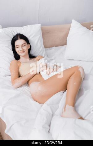 giovane donna allegra con vitiligine sdraiata a letto Foto Stock