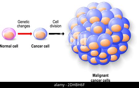 Cellule umane normali rinascono a cellule tumorali e crescono a tumori maligni. Anatomia umana Illustrazione Vettoriale