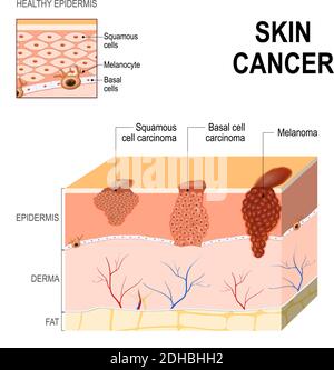 Cancro della pelle: Carcinoma a cellule squamose (malattia delle cellule più anziane sulla pelle di superficie), cancro delle cellule basali (inizia nelle cellule basali) e melanoma Illustrazione Vettoriale