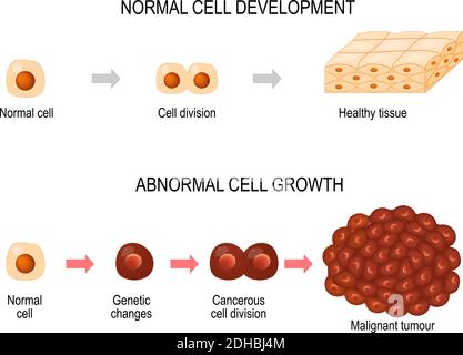 Cancer cells. Illustrazione che mostra sviluppo di malattia di cancro. Tessuto sano e tumore maligno. Diagramma vettoriale per il vostro progetto, educativo Illustrazione Vettoriale