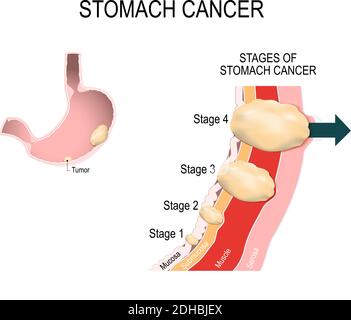 Le fasi cliniche del cancro allo stomaco. Classificazione dei tumori maligni. Illustrazione vettoriale per uso medico Illustrazione Vettoriale