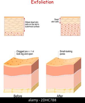 L'esfoliazione è la rimozione delle vecchie cellule morte della pelle sulla superficie esterna della pelle. Sezione trasversale degli strati della pelle prima e dopo l'esfoliazione. Primo piano Illustrazione Vettoriale