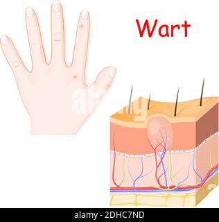 verruche su una mano. sezione trasversale di verruca dettagliata. Illustrazione vettoriale per uso medico Illustrazione Vettoriale