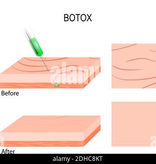 Applicazioni di riempimento cosmetico Botox. Per la riduzione delle rughe facciali. Iniezione di botox nei muscoli sotto le rughe facciali Illustrazione Vettoriale