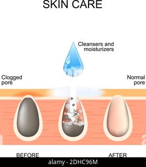 Cura della pelle. Pori ostruiti e normali. Prima e dopo l'uso di scrub, detergenti e idratanti Illustrazione Vettoriale