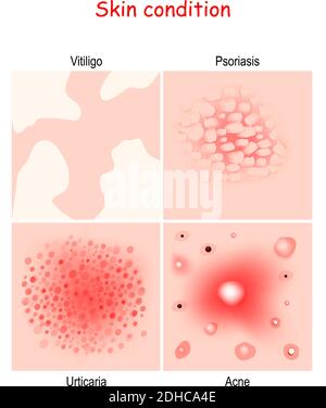 Condizioni della pelle e malattie. Primo piano di Acne, orticaria, psoriasi, Vitiligo. Diagramma vettoriale per l'istruzione, medico, uso scientifico Illustrazione Vettoriale