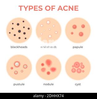 Tipi di acne. Problema di infezione della pelle, cisti di tipo e grado dei pimples, whitehead, blackheads, nodulo e cistico. Serie di vettori di malattia dei pori del derma Illustrazione Vettoriale