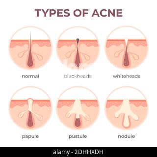 Anatomia dei tipi di acne. Pimple malattie vista in sezione testa nera, cistica e whitehead. Struttura infografica del vettore di infezione della pelle e dei pori Illustrazione Vettoriale