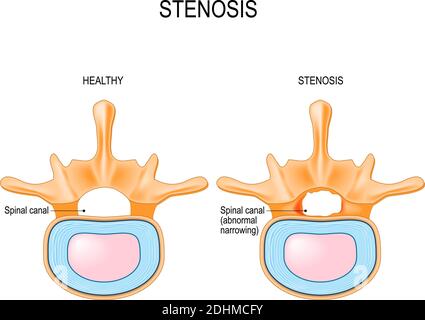 La stenosi spinale lombare è un restringimento anormale nel canale spinale. Sezione della colonna vertebrale umana e sezione trasversale del midollo spinale. Vettore Illustrazione Vettoriale