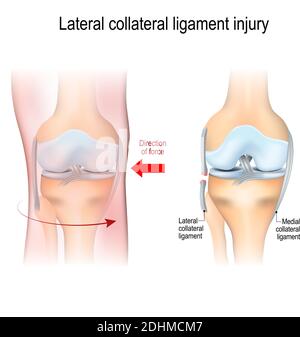 Lesione del legamento collaterale fibolare. Anatomia articolare. Illustrazione vettoriale per uso biologico, medico, scientifico ed educativo Illustrazione Vettoriale