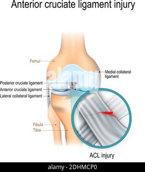 Lesione del legamento crociato anteriore. Anatomia articolare. Illustrazione vettoriale per uso biologico, medico, scientifico ed educativo Illustrazione Vettoriale