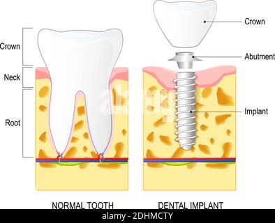 Impianto dentale e dente normale su sfondo bianco. Anatomia del dente. Illustrazione che mostra il taglio di closeup dell'osso della mandibola inferiore Illustrazione Vettoriale