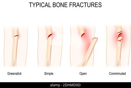 Fratture ossee tipiche: Greenstick, semplice, aperto, sminuzzato. Schema vettoriale per uso medico Illustrazione Vettoriale