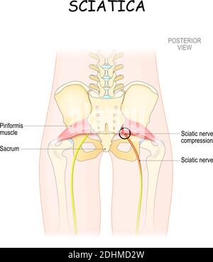 sindrome di piriformis. illustrazione vettoriale medica. sciatica e cause. corpo del paziente dalla parte posteriore. vista posteriore Illustrazione Vettoriale
