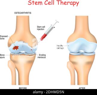La terapia delle cellule staminali per il dolore nell'osteoartrite, nelle ginocchia e nelle anche utilizza le proprietà curative delle proprie cellule, prese dal midollo osseo o dal grasso adiposo Illustrazione Vettoriale