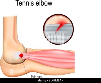 Gomito da tennis o epicondilite laterale. Illustrazione vettoriale per uso medico Illustrazione Vettoriale