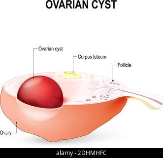 Cisti ovarica Un sacco riempito di liquido nell'ovaio. Illustrazione Vettoriale
