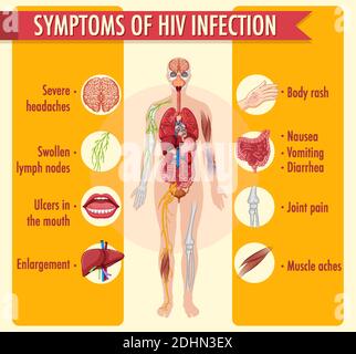 Sintomi di infezione da HIV illustrazione infografica Illustrazione Vettoriale