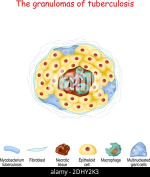 I granulomi della tubercolosi. Struttura dei granulomi dal tessuto necrotico, dalle cellule epitelioidi e dai macrofagi, alle cellule giganti multinucleate Illustrazione Vettoriale
