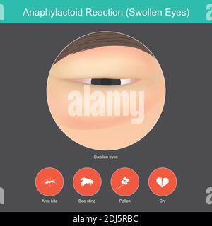 Reazione anafilattoide. L'illustrazione mostra da vicino intorno all'occhio da un sintomo nella reazione la risposta del sistema immunitario. Illustrazione Vettoriale