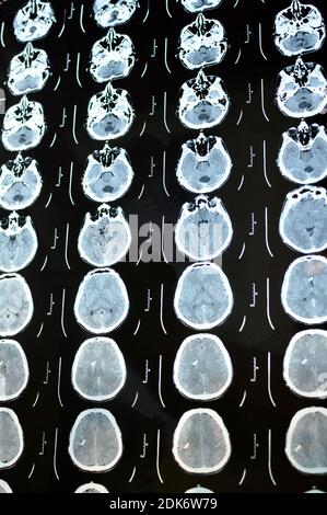 Scansione dell'immagine tomografica computerizzata del cervello. Pellicola TC di un cranio umano e di un cervello con shunt intracranico. Background neurologico. Medicina, scienza, vert Foto Stock