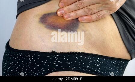 Mani di donna anziana esamina violaceo grande livido o ematoma e tocca con le dita. Trauma sottocutaneo da violenza domestica o lesioni. Primo piano Foto Stock
