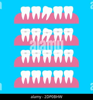 Correzione dei denti con le bretelle ortodontiche. Illustrazione del vettore di trattamento ortodontico del dente. Prima e dopo il concetto di correzione dei denti delle bretelle dentali Illustrazione Vettoriale