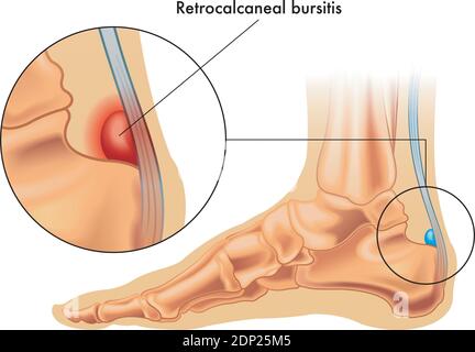 Illustrazione che mostra la posizione della normale borsa retrocalcanea nel piede, e in dettaglio ingrandito una borsite retrocalcanea, annotata in bianco Illustrazione Vettoriale