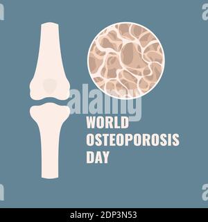 Osteoporosi, illustrazione concettuale. Foto Stock