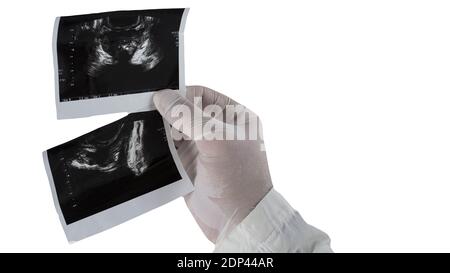 Ecografia della prostata maschile isolato su sfondo bianco, il medico tiene in mano un'immagine della prostata. Foto Stock