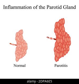 Infiammazione della ghiandola parotide. La struttura della ghiandola salivare parotide. Illustrazione vettoriale su sfondo isolato Illustrazione Vettoriale