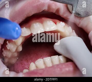 Primo piano dell'ortodontista che utilizza gli strumenti dentali durante la pulizia dei denti del paziente con il divaricatore della guancia in bocca e le staffe sui denti che ricevono il trattamento dentale. Concetto di igiene dentale professionale Foto Stock