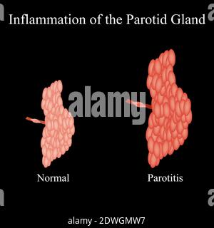 Infiammazione della ghiandola parotide. La struttura della ghiandola salivare parotide. Illustrazione vettoriale su sfondo isolato Illustrazione Vettoriale