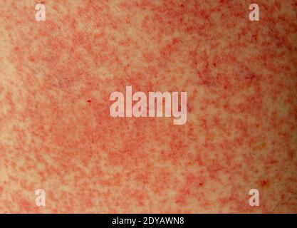Una reazione allergica (effetto collaterale) alla penicillina (amoxicillina) sulla pelle di un uomo bianco di 51 anni a Londra, Regno Unito. Foto Stock