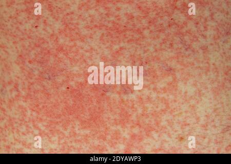Una reazione allergica (effetto collaterale) alla penicillina (amoxicillina) sulla pelle di un uomo bianco di 51 anni a Londra, Regno Unito. Foto Stock