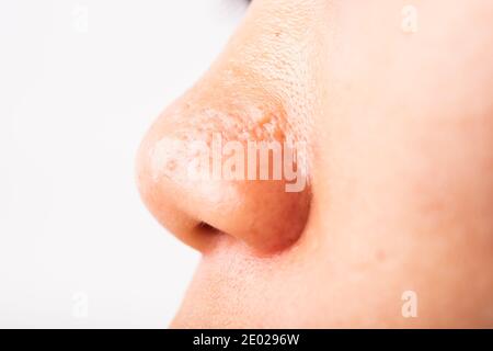 Closeup Asian giovane donna grandi pori hanno fleckles guancia oleosa, acne pimple sul naso, studio girato isolato su sfondo bianco, Healthcare bellezza pelle Foto Stock