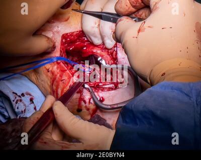 un chirurgo vascolare prepara un'arteria della gamba per la chirurgia di bypass Foto Stock