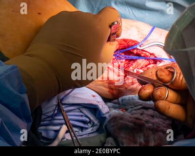 un chirurgo vascolare prepara un'arteria della gamba per la chirurgia di bypass Foto Stock