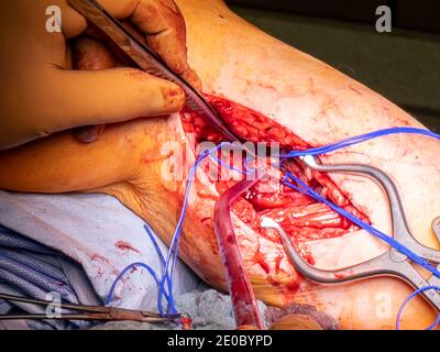 un chirurgo vascolare prepara un'arteria della gamba per la chirurgia di bypass Foto Stock