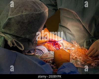 un chirurgo vascolare prepara un'arteria della gamba per la chirurgia di bypass Foto Stock