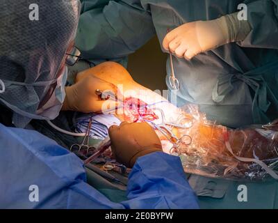 un chirurgo vascolare prepara un'arteria della gamba per la chirurgia di bypass Foto Stock