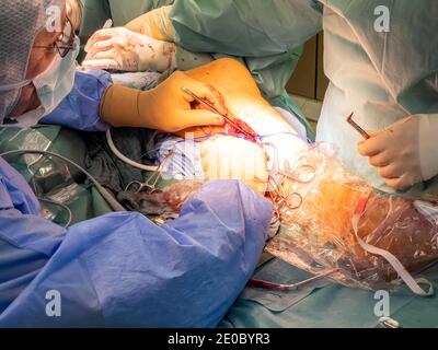 un chirurgo vascolare prepara un'arteria della gamba per la chirurgia di bypass Foto Stock