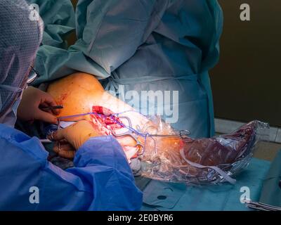 un chirurgo vascolare prepara un'arteria della gamba per la chirurgia di bypass Foto Stock