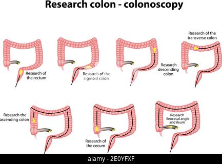 Colonscopia. Diagnosi del colon. Infografiche. Illustrazione vettoriale su sfondo isolato Illustrazione Vettoriale