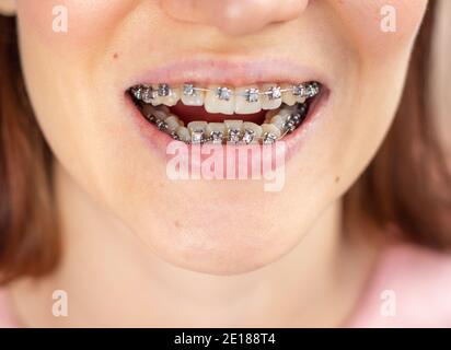 sistema a scrigno in bocca sorridente, macro denti foto, primo piano labbra, macro shot.