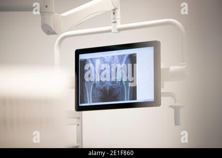 immagine di una radiografia dell'anca su uno schermo in un sala operatoria Foto Stock