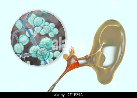 Otite fungina cronica media infezione dell'orecchio, illustrazione Foto Stock