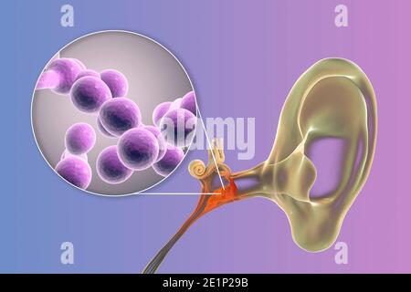 Otite fungina cronica media infezione dell'orecchio, illustrazione Foto Stock