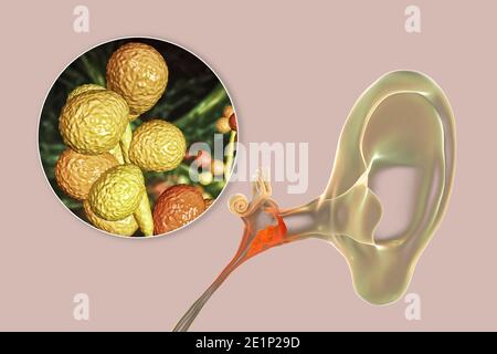 Otite fungina cronica media infezione dell'orecchio, illustrazione Foto Stock