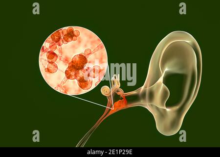 Otite fungina cronica media infezione dell'orecchio, illustrazione Foto Stock